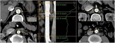 Reference values of normal abdominal aortic areas in Chinese population measured by contrast-enhanced computed tomography